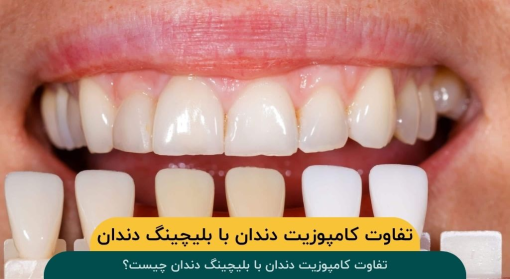 تفاوت-کامپوزیت-دندان-با-بلیچینگ-دندان